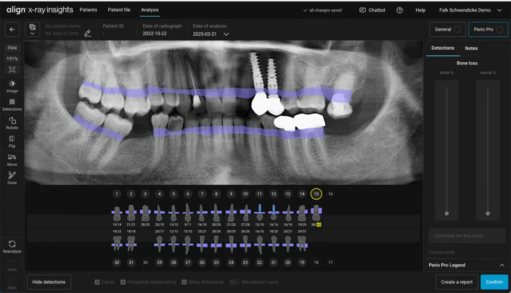 Abb. 3: Das zuvor gezeigte System (align x-ray insights, align technologies, Berlin, Germany) markiert parodontalen Knochenabbau auf Panoramaschichtbildern und hebt den am schwersten betroffenen Zahn gelb hervor. Die berechneten Knochenabbauwerte können im Rahmen des parodontalen Stagings und Gradings eingesetzt werden.