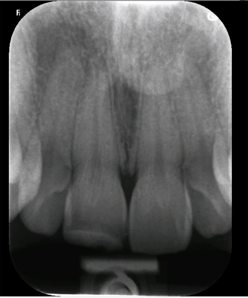 Abb. 1: Röntgenbild ohne periapikale Läsionen.