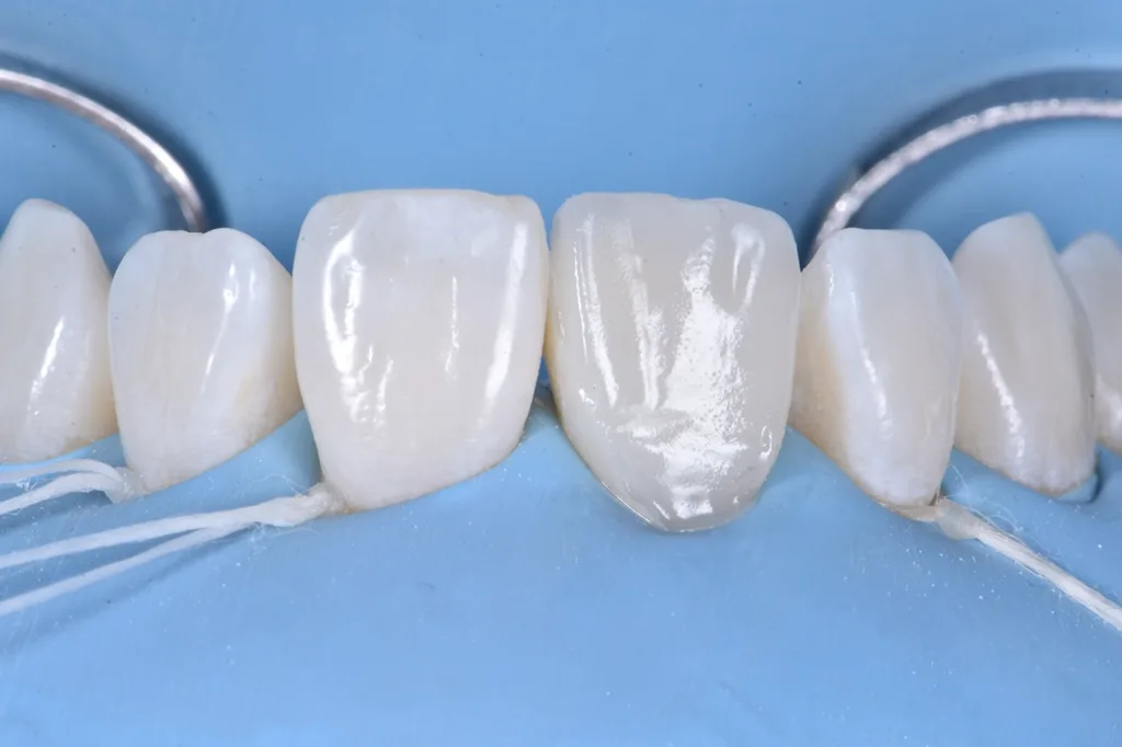 Abb. 11: Abschluss der Schichtung mit Komposit- Schmelzmasse.