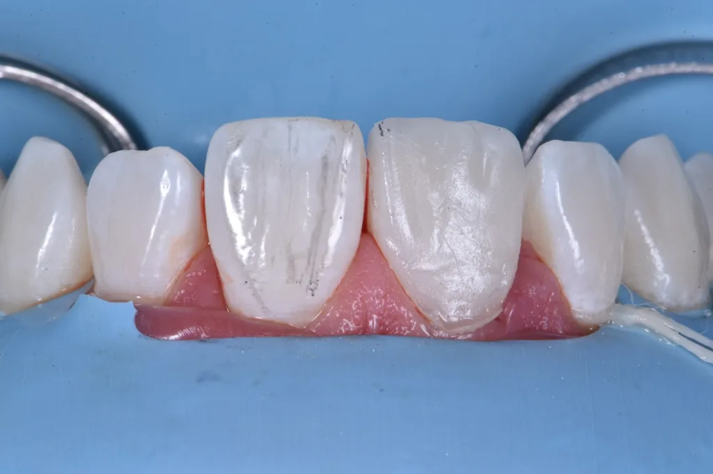 Abb. 12: Nachbildung der Übergangslinien des Zahns 21 beim Finieren.