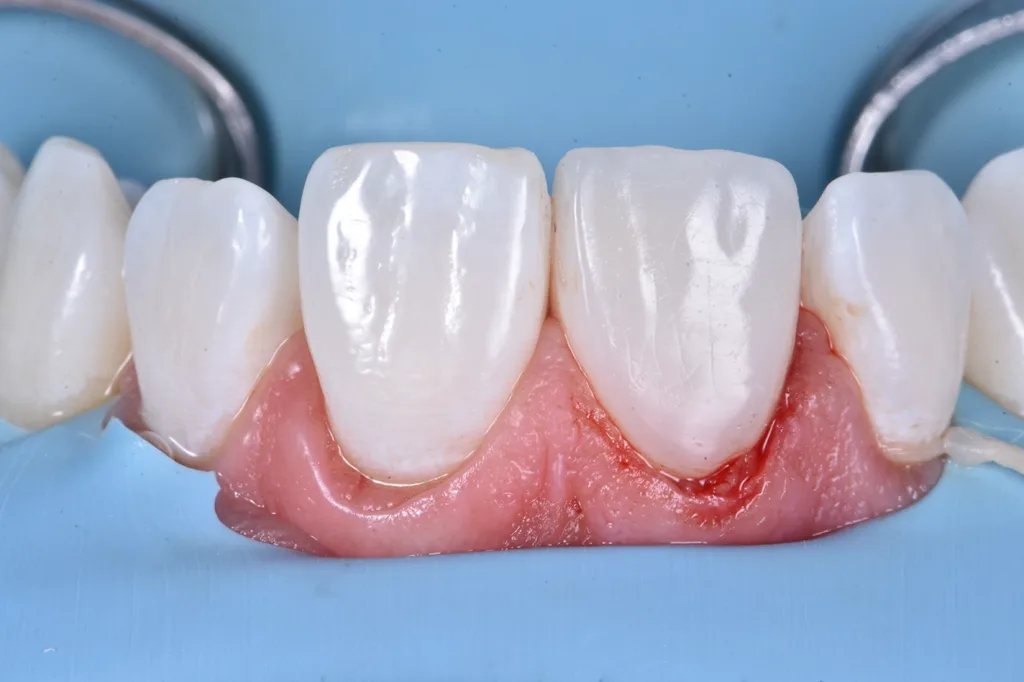 Abb. 13: Nachbildung von Zahn 21 bei Politur.