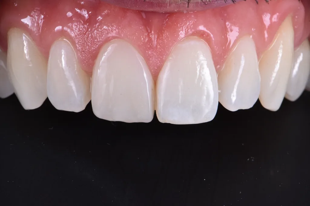 Abb. 14: Restauration nach 21 Tagen.