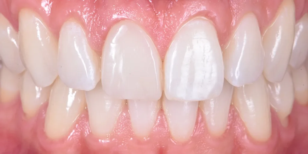 Abb. 15: Restauration nach 21 Tagen.