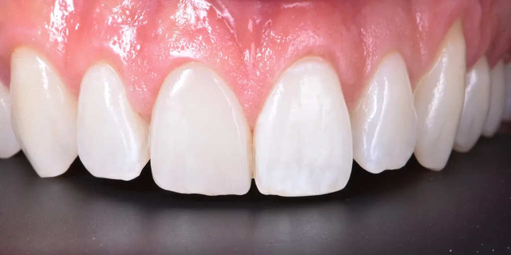 Abb. 16: Restauration nach zwölf Monaten.