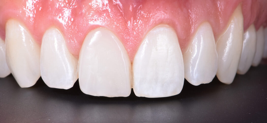 Restauration nach zwölf Monaten