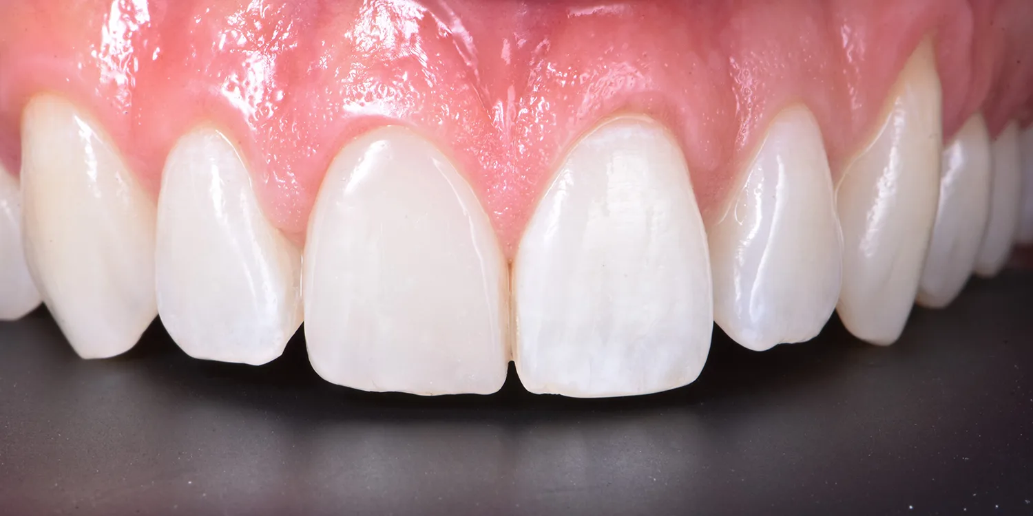 Restauration nach zwölf Monaten