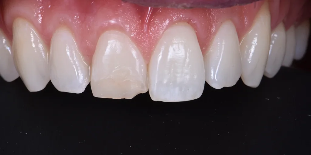 Abb. 2: Verfärbung und leicht nach palatinal geneigter Zahn 11.