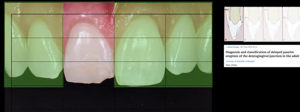 Abb. 3: Die Ästhetikanalyse zeigt eine Asymmetrie des gingivalen Zenits.
