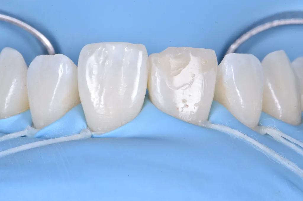 Abb. 4: Isolierung von Zahn 11 mit Kofferdam.