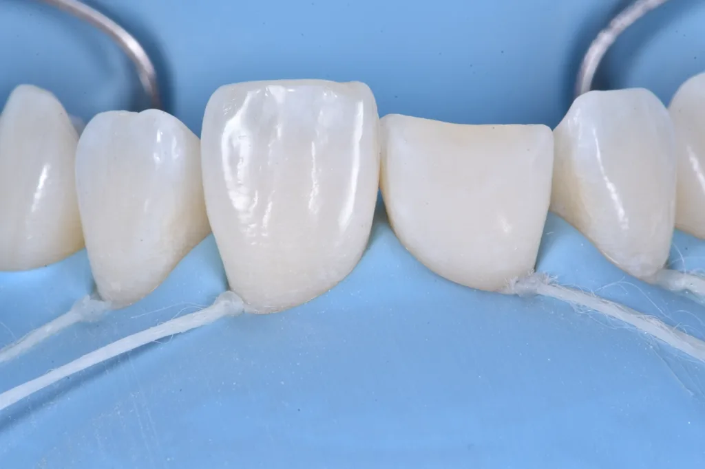 Abb. 5: Entfernung von frakturierter Kompositrestauration.