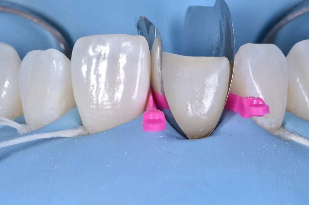 Abb. 6: Verwendung von Matrize und Adhäsion mit 3-Schritt-Etsch-and-Rinse-System.