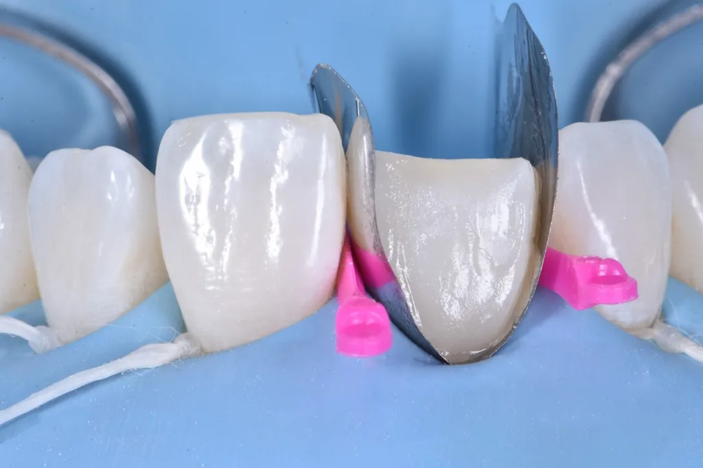 Abb. 7: Nachbildung des vestibulären Emergenzprofils mit einer Schichtmasse aus Schmelzkomposit.