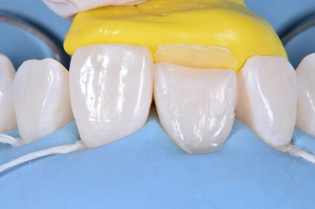 Abb. 8: Rekonstruktion der palatinalen Wand mit Schmelzkomposit.