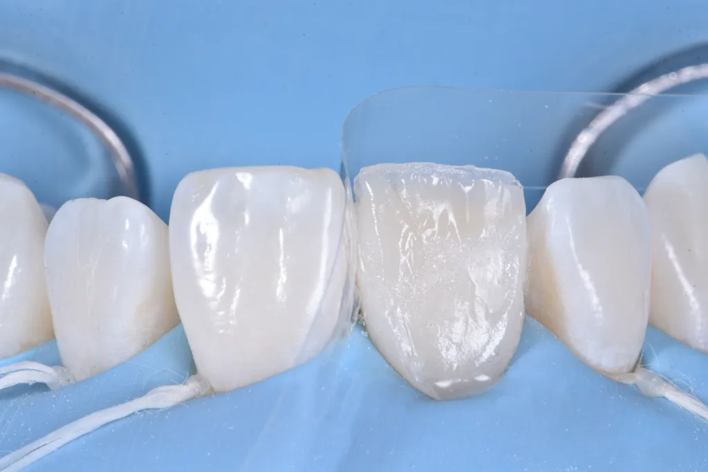 Abb. 9: Rekonstruktion der Dentinanatomie mit einem opaken Dentinkomposit.