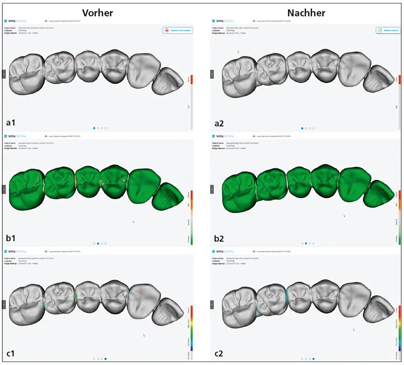 Abb. 2a1–c2: Bilder einer Vorher-nachher-Simulation. Abb. 2a1 und a2 zeigen die Vorher-nachher-Situation in Bezug auf die Material-Limit-Überschreitung; Abb. 2b1 und b2 beziehen sich auf den Materialbedarf (wo sollte man Material auftragen, wo kann man etwas abtragen). Abb. 2c1 und c2 beziehen sich auf die Spannungsverhältnisse.