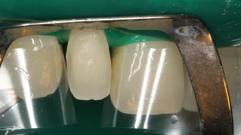 Abb. 10: Die mit dem Tooth Primer beschickte Klebefläche des Zahnes 12.