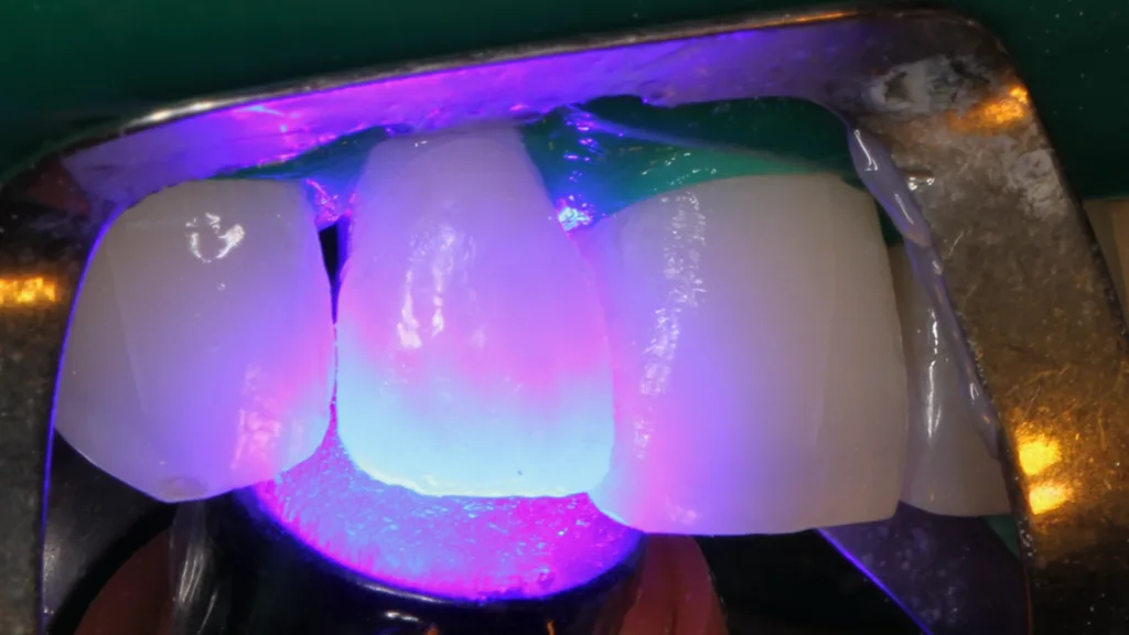 Abb. 11: Polymerisation des Veneerklebers an Zahn 12 mit einem Hochleistungs-LED-Polymerisationsgerät. 