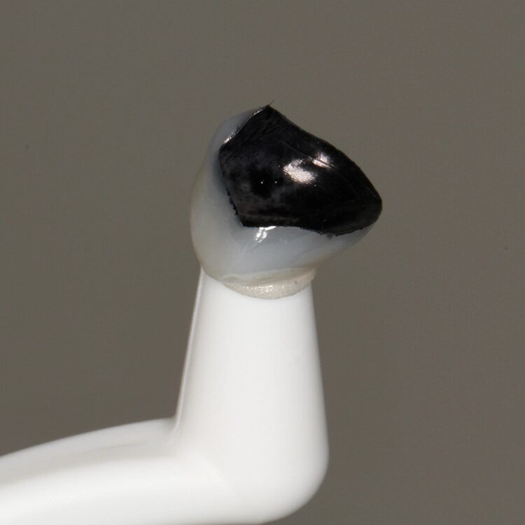 Abb. 12: Farbliche Markierung der abzustrahlenden Fläche des Veneers für Zahn 23.