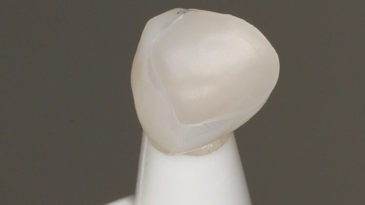 Abb. 13: Die mit SilJet abgestrahlte Zirkonoxid-Klebefläche des Veneers für Zahn 23.