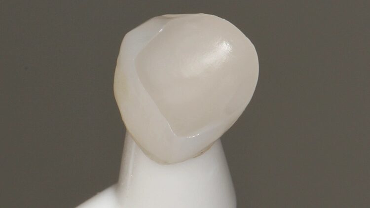 Abb. 14: Die mit dem MDP/Silan-haltigen Universalprimer versehene Veneerklebefläche.