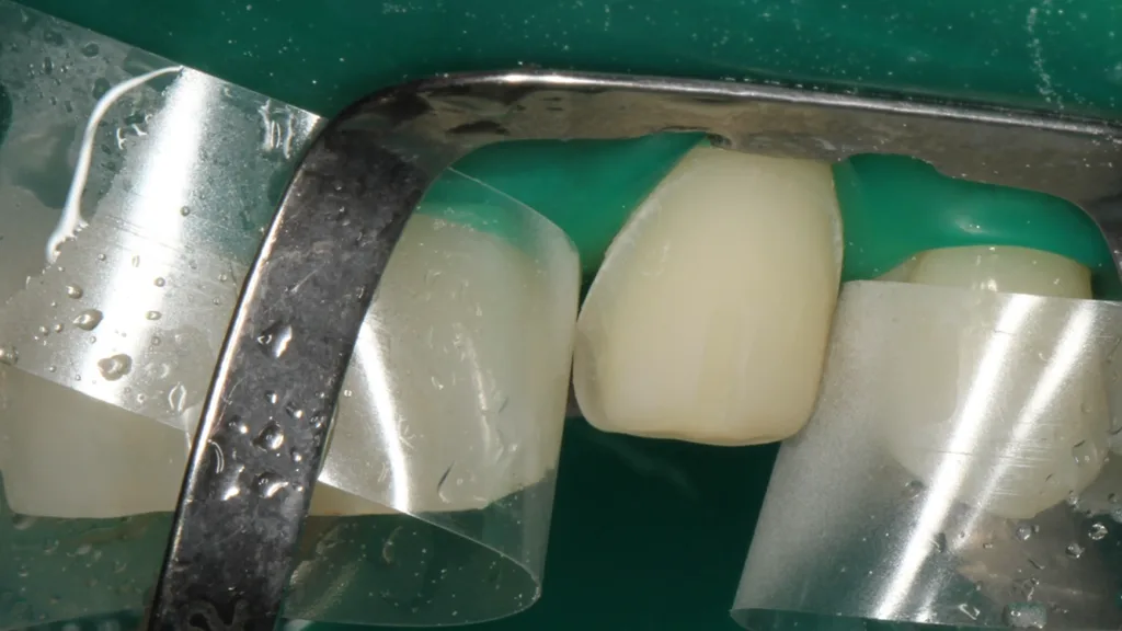 Abb. 15: Die isolierte Klebefläche an Zahn 23 bereits nach dem Abstrahlen mit Al2O3.