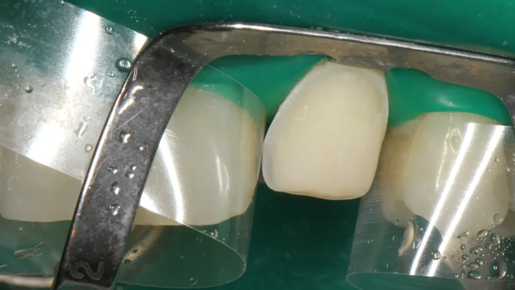 Abb. 16: Die Klebefläche des Zahnes 23 nach der Phosphorsäureätzung.