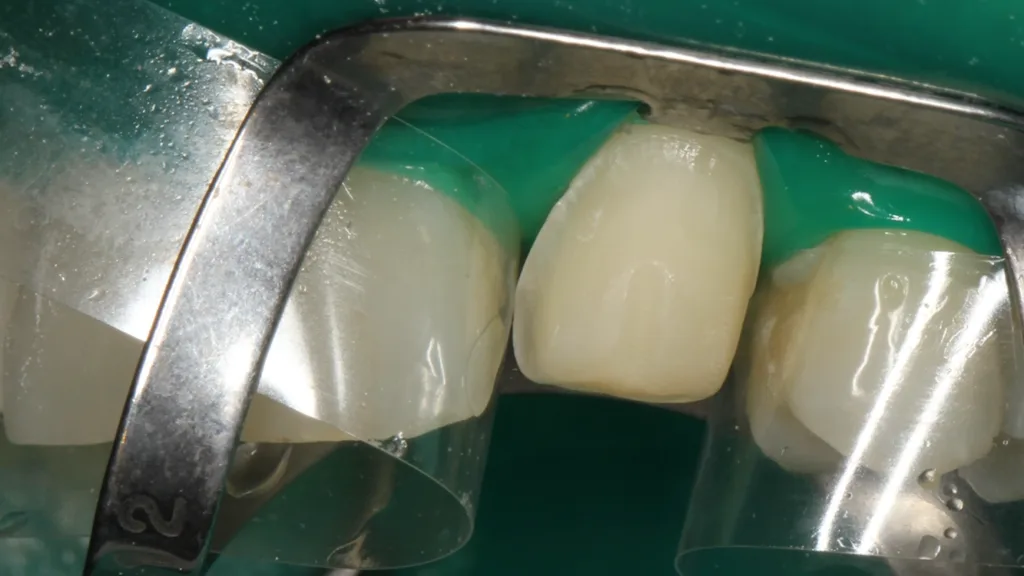 Abb. 17: Die mit dem Tooth Primer beschickte Klebefläche des Zahnes 23. 