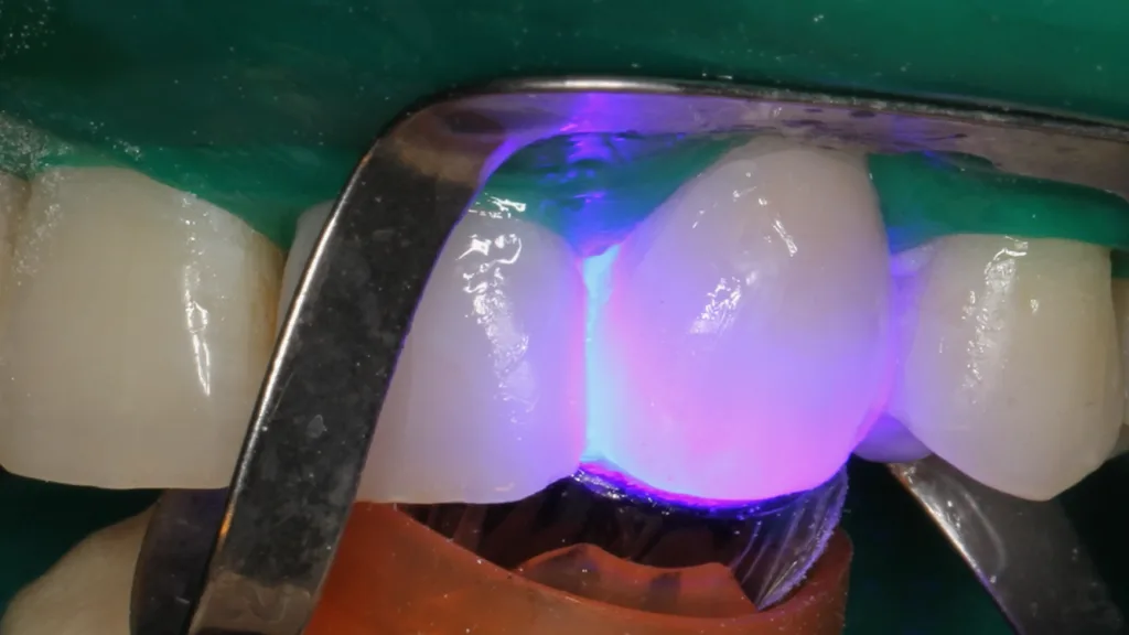 Abb. 18: Polymerisation des Veneerklebers an Zahn 23 mit einem Hochleistungs-LED-Polymerisationsgerät.