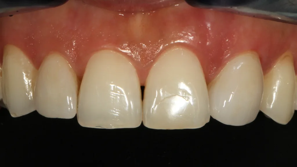 Abb. 19: Die eingeklebten Zirkonoxid-Veneers auf den Zähnen 12 und 23.