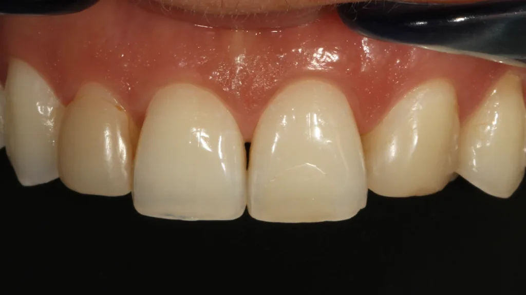 Abb. 1: En-face-Aufnahme einer Patientin mit mesialisiertem Zahn 23. Die Zähne 12 und 23 wurden mittels direkter Komposit-Veneers aufgebaut, die sich inzwischen verfärbt hatten.