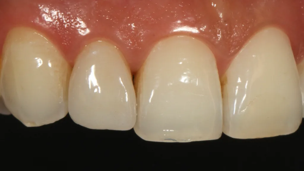 Abb. 20: Detailaufnahme des Veneers an Zahn 12.