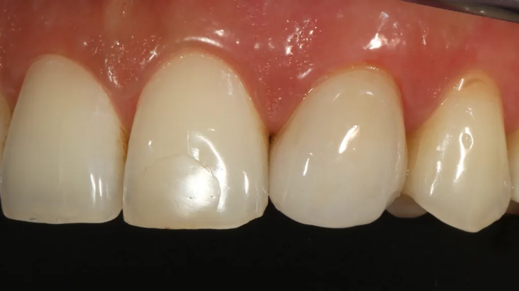 Abb. 21: Detailaufnahme des Veneers an Zahn 23.