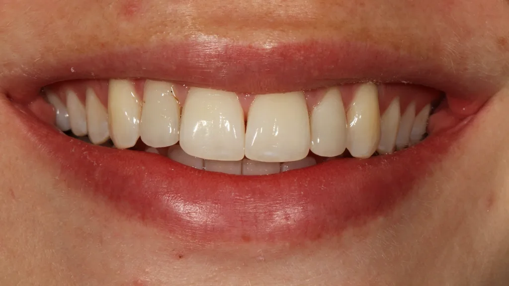 Abb. 23: Die 31-jährige Patientin wurde alio loco mit Lithiumdisilikat-Veneers versorgt. 