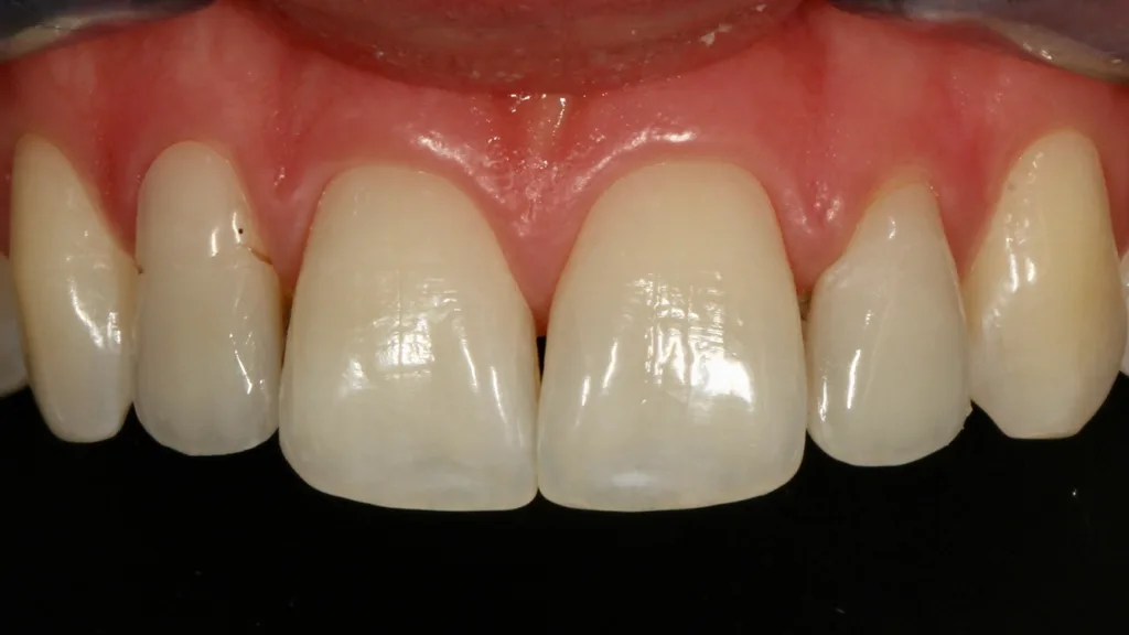 Abb. 24: Klinisch imponiert primär eine Zahnhalsdefekt-Reparatur an Zahn 12.