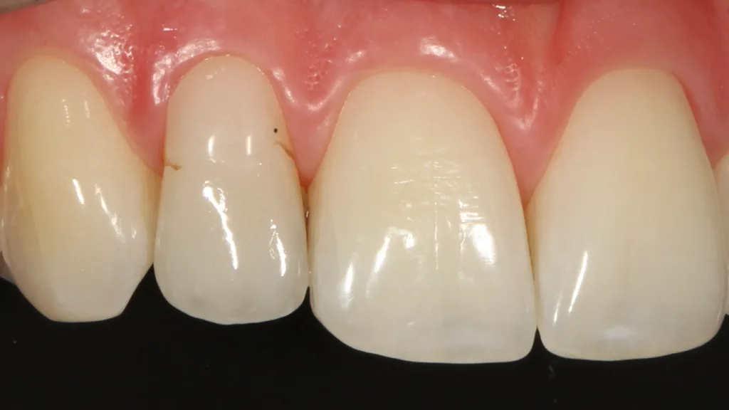 Abb. 25: Detailaufnahme des reparierten Veneers an Zahn 12.