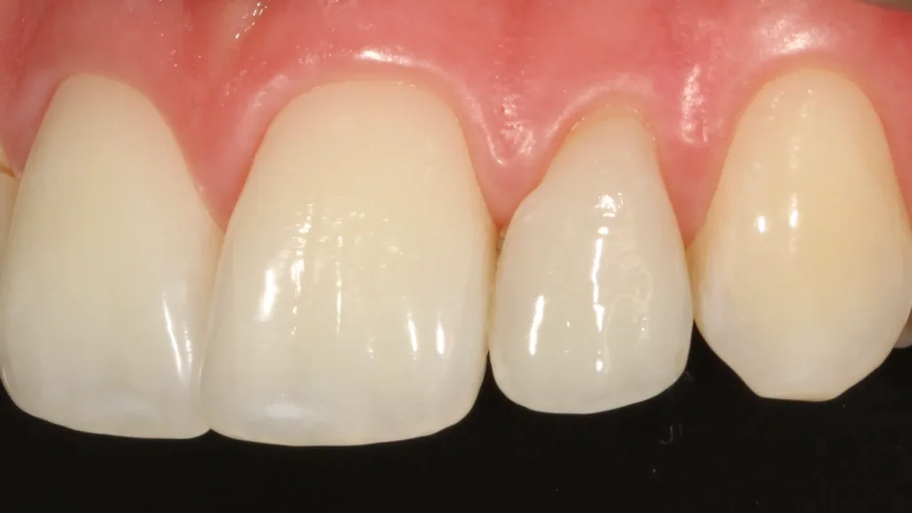 Abb. 26: An Zahn 22 stört die Konkavität der mesialen Kurvatur des Zahnes 22 und erschwerte die Reinigungsfähigkeit in diesem Bereich.