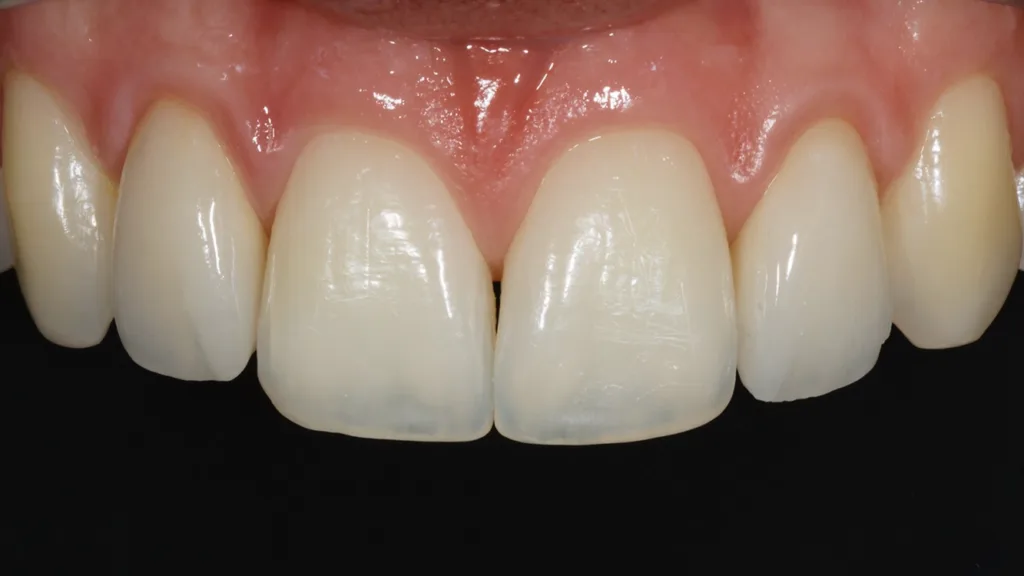 Abb. 27: Neuversorgung der Zähne 12 und 22 mit Zirkonoxid-Veneers. 