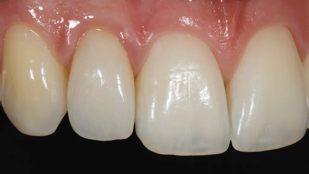 Abb. 28: Detailaufnahme des neu versorgten Zahnes 12.