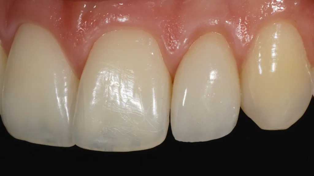 Abb. 29: Detailaufnahme des neu versorgten Zahnes 22: Die mesiale Approximalfläche ist nun anatomisch besser geformt und einfacher zu reinigen. 