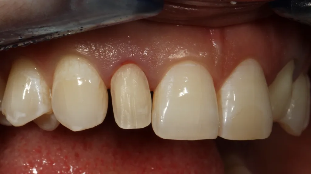 Abb. 3: Nach Entfernung der Kompositüberschichtung: Nachpräparation für eine Veneerversorgung.