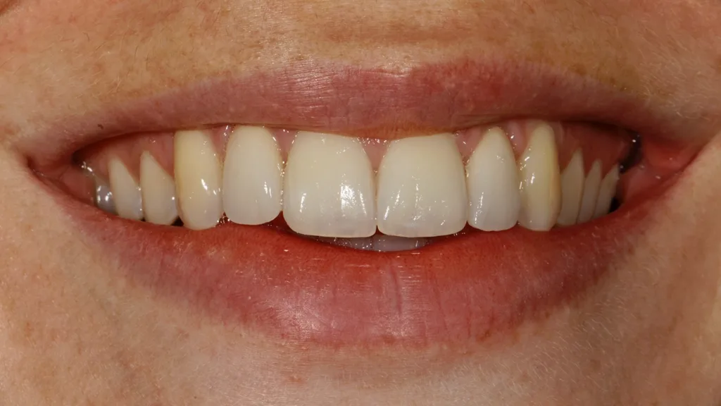 Abb. 30: Die Patientin ist nun endlich mit ihrer Veneerversorgung zufrieden.