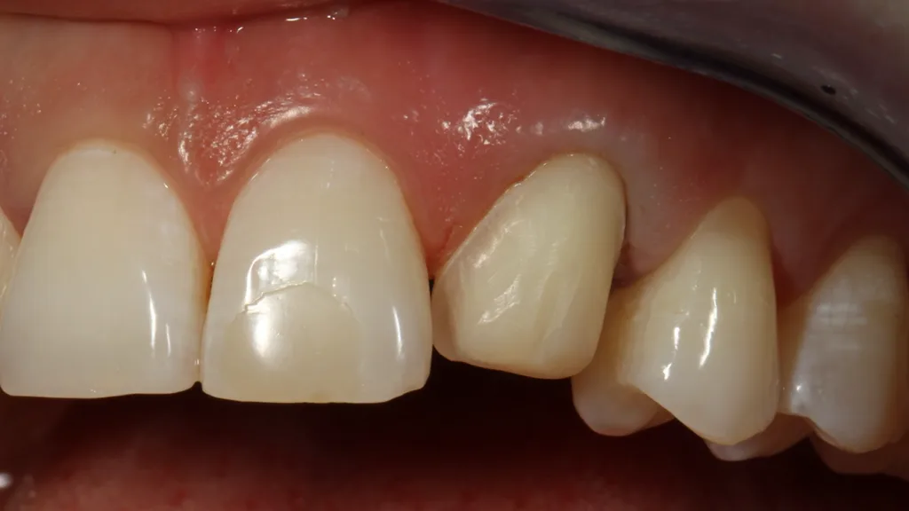 Abb. 4: Vergleichbare Nachpräparation am 
mesialisierten Eckzahn unter Einfassung der Inzisalkante.