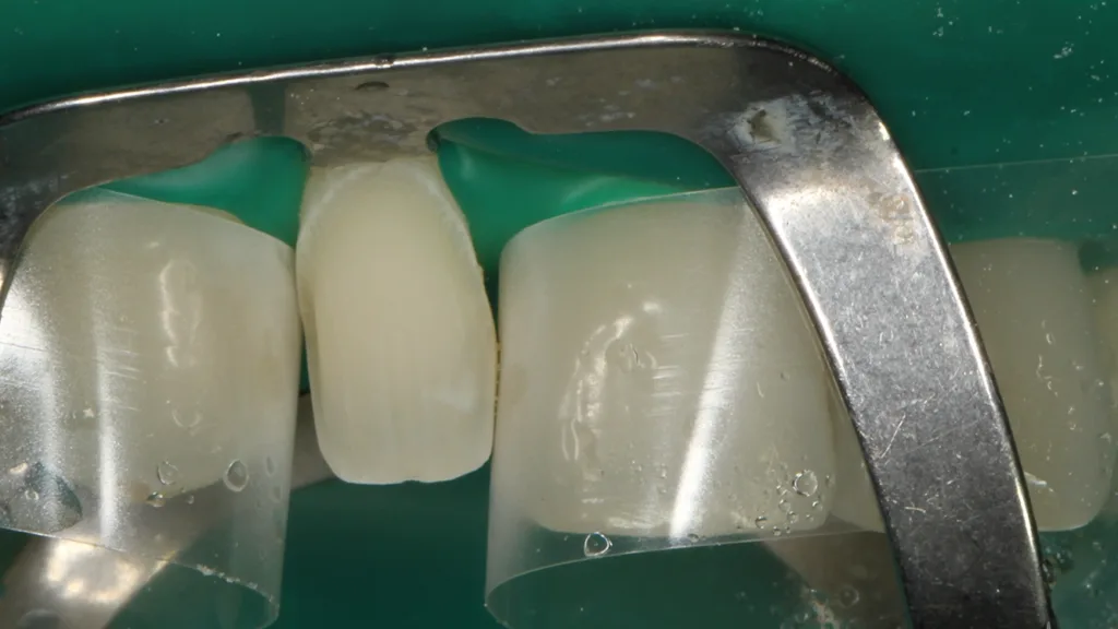 Abb. 8: Die isolierte Klebefläche an Zahn 12 bereits nach dem Abstrahlen mit Al2O3.