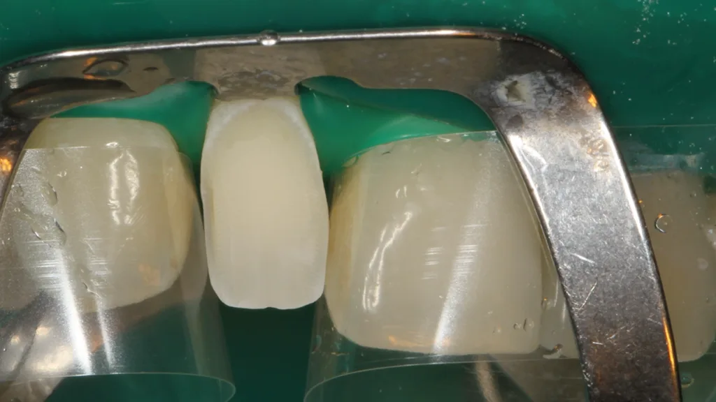 Abb. 9: Die Klebefläche des Zahnes 12 nach der 
Phosphorsäureätzung.