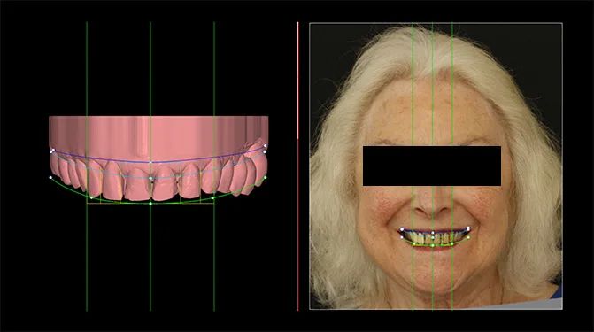 Abb. 3: Festlegung von Achsen, Proportionen und Symmetrien im Digital Smile 
Design (durchgeführt von der behandelnden Zahnarztpraxis)