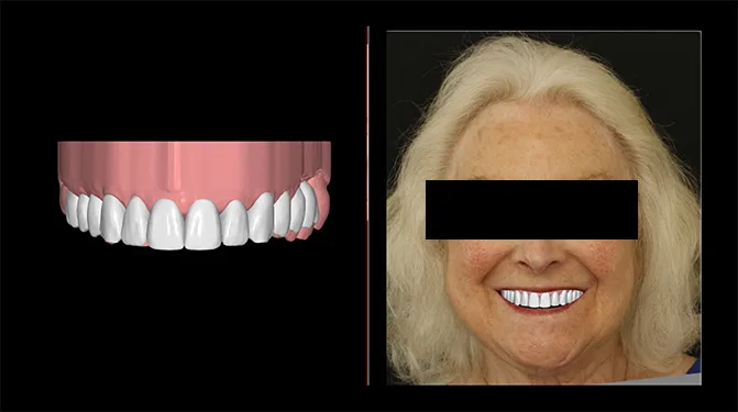 Abb. 4: Digital Smile Design (DSD): Visualisierung eines möglichen Ergebnisses 
für die Patientin