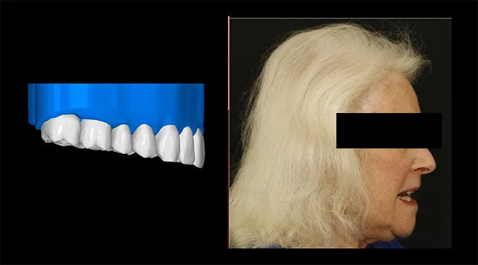 Abb. 5: Digital Smile Design (DSD): Visualisierung der Zahnstellungskorrektur