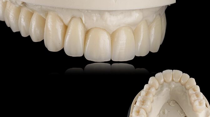 Abb. 8: Definitive Restauration aus Zirkonoxid, geschichtet mit NovaCer Keramik