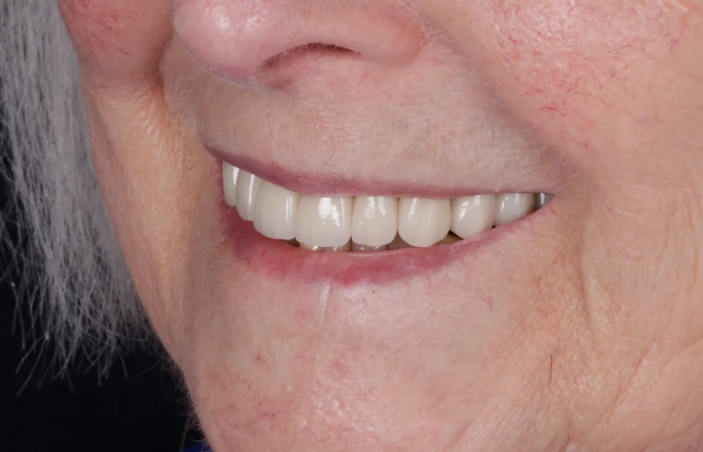 Abb. 9a und b: Definitive Restauration in situ