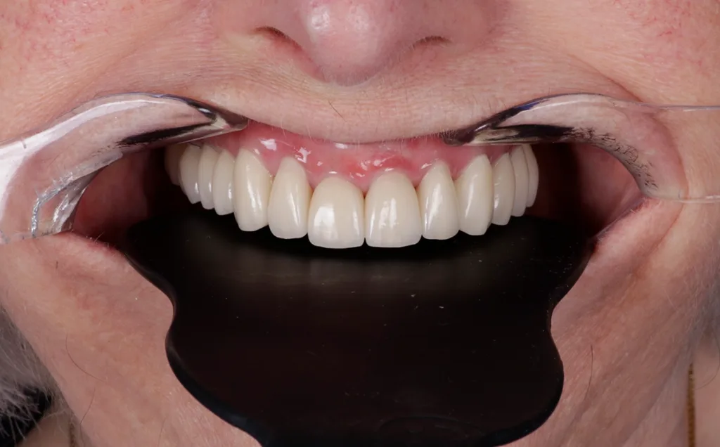 Abb. 9a und b: Definitive Restauration in situ